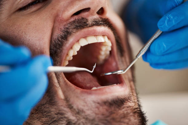 Best Emergency Dental Care for Broken or Chipped Teeth in Weddington, NC
