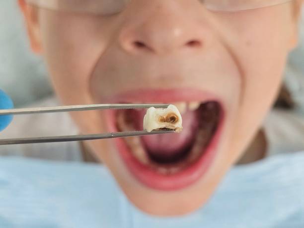 Best Urgent Care for Lost Fillings or Crowns in Weddington, NC