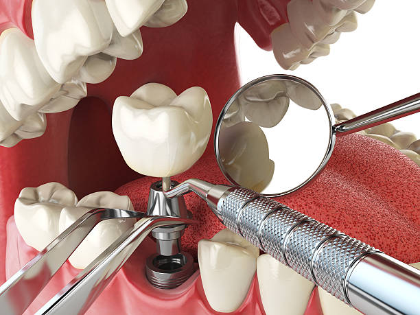 Best Emergency Treatment for Dental Infections or Abscesses in Weddington, NC